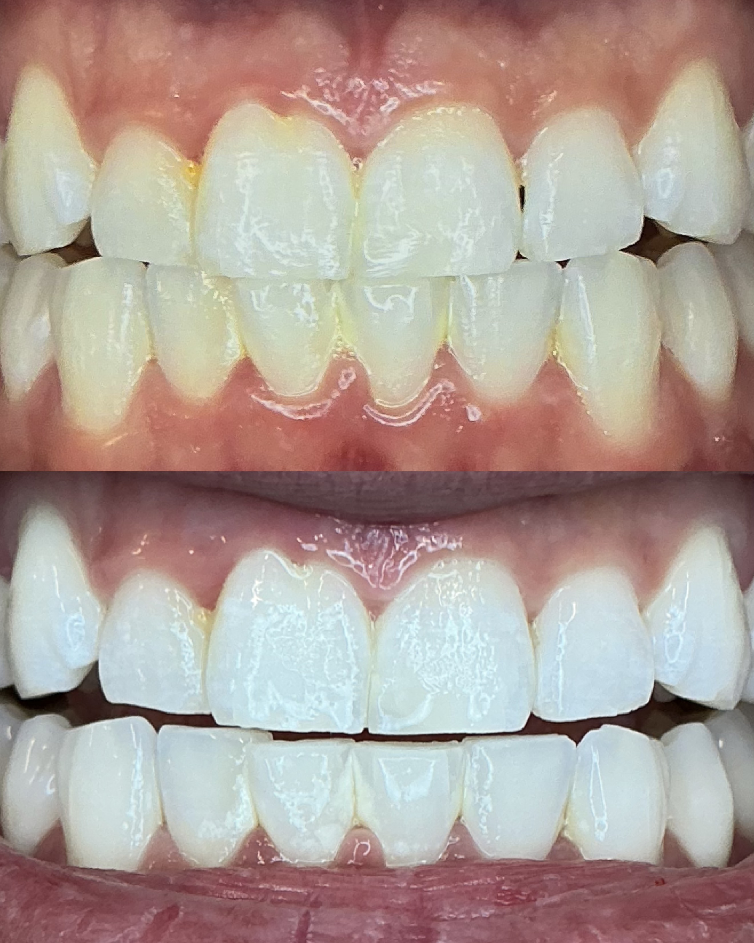 Before and after teeth whitening