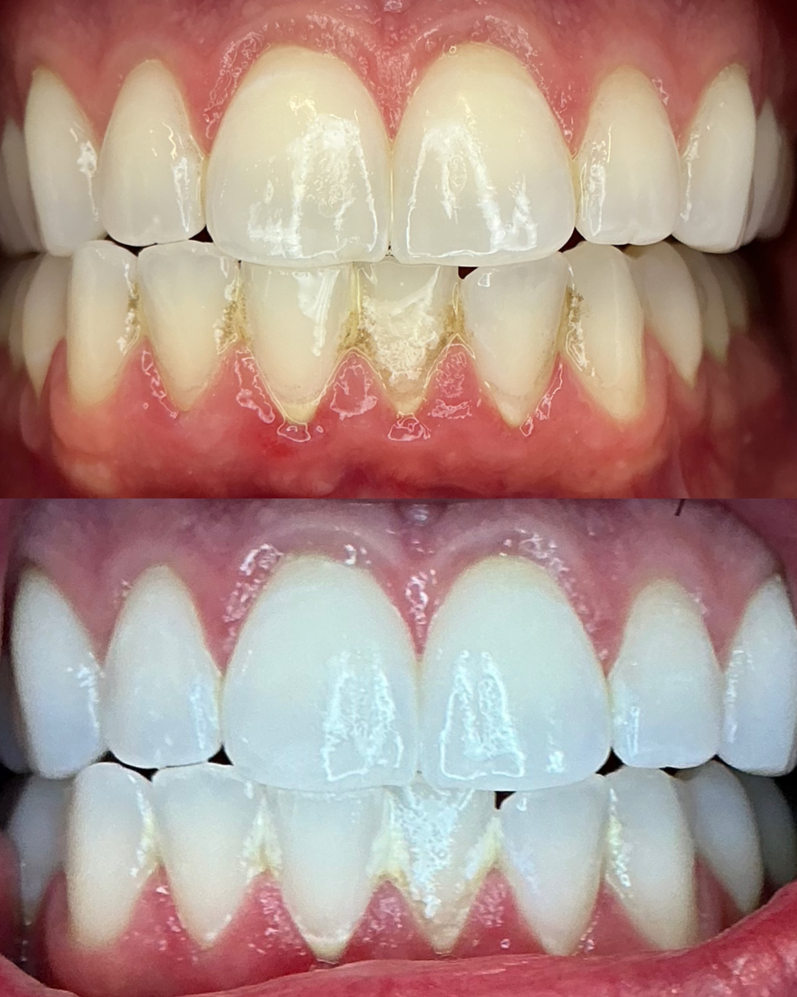 Before and after teeth whitening