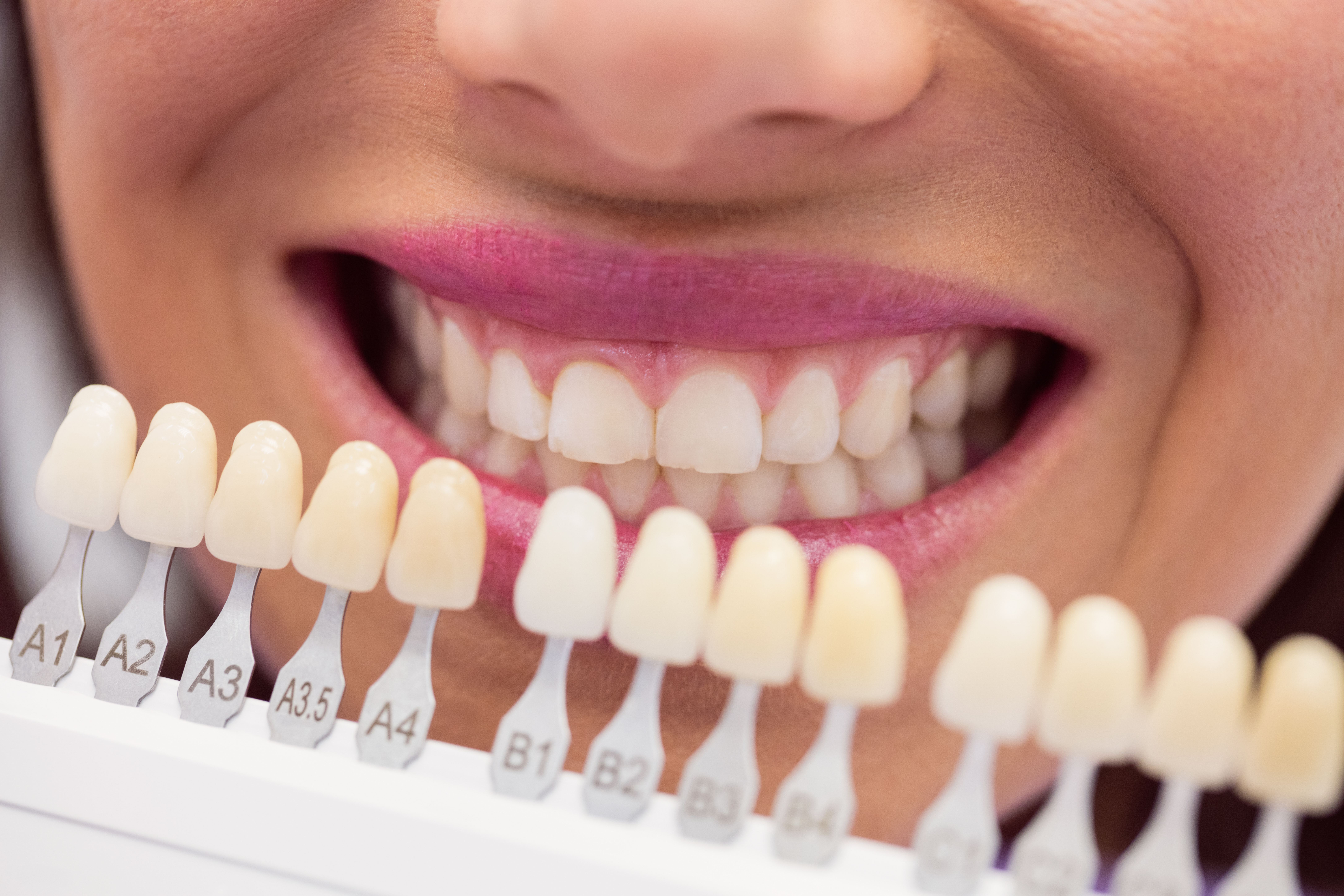 Professional teeth whitening treatment