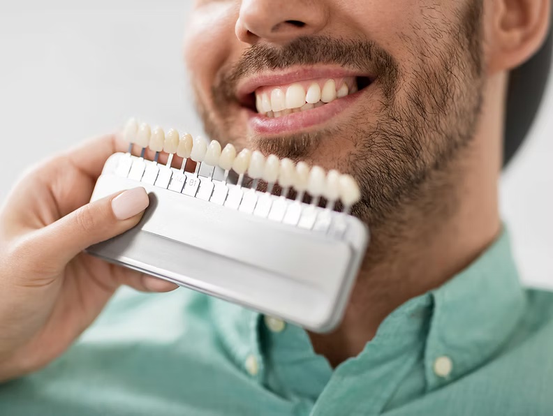 Professional teeth whitening with shade guide