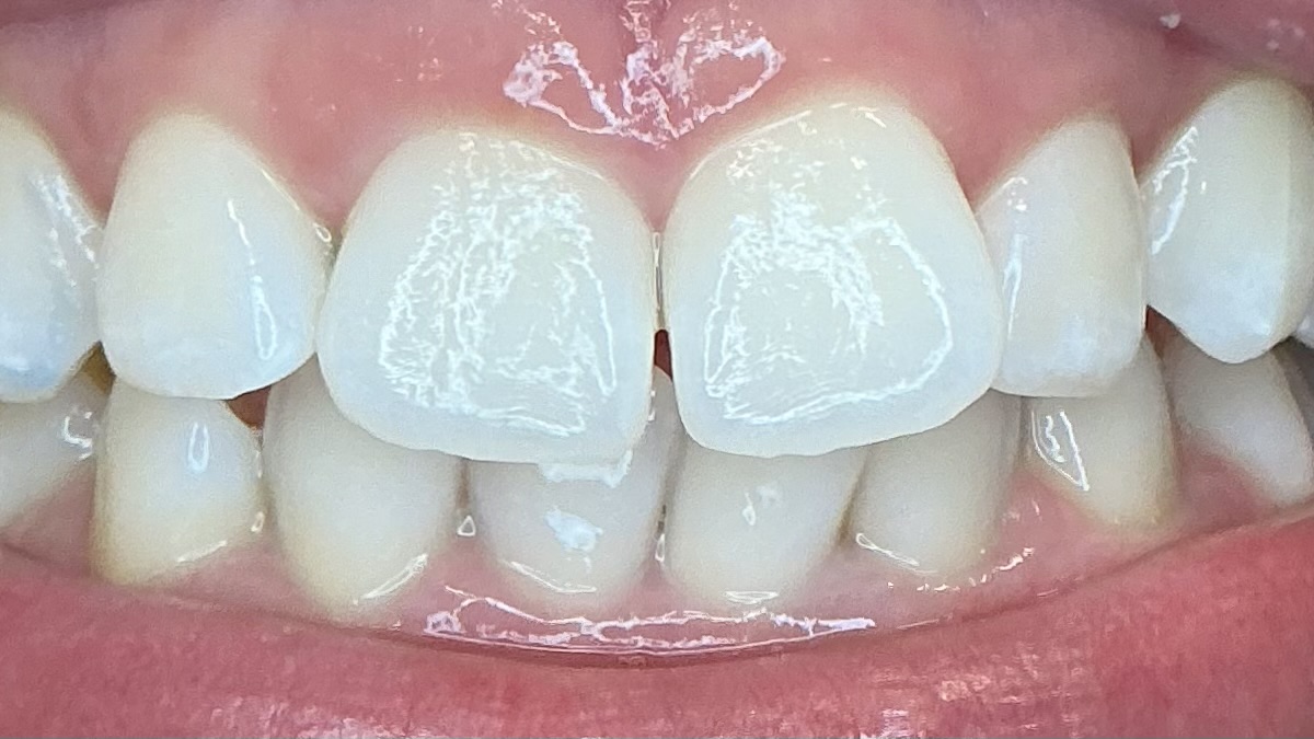 After teeth whitening