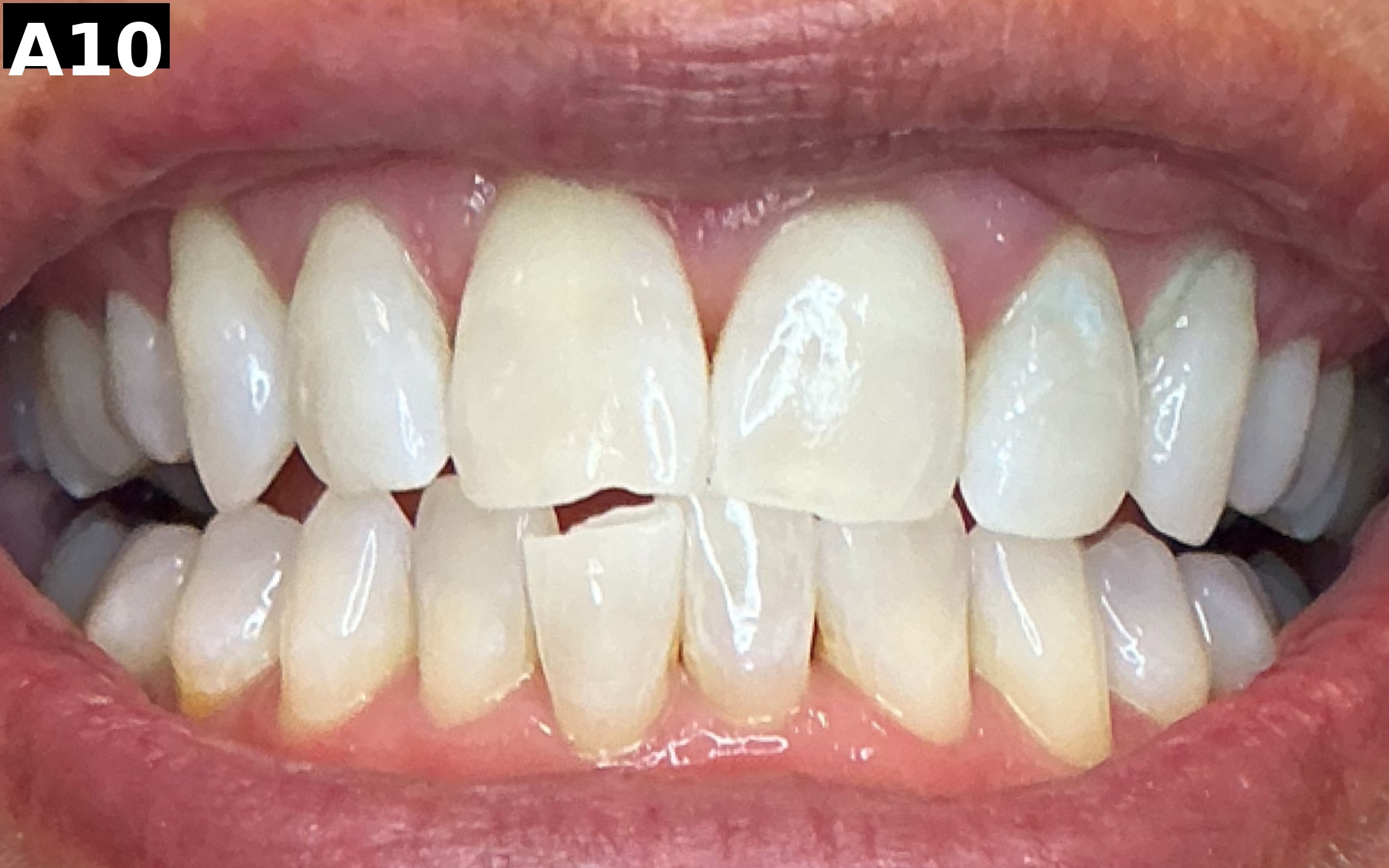 After teeth whitening