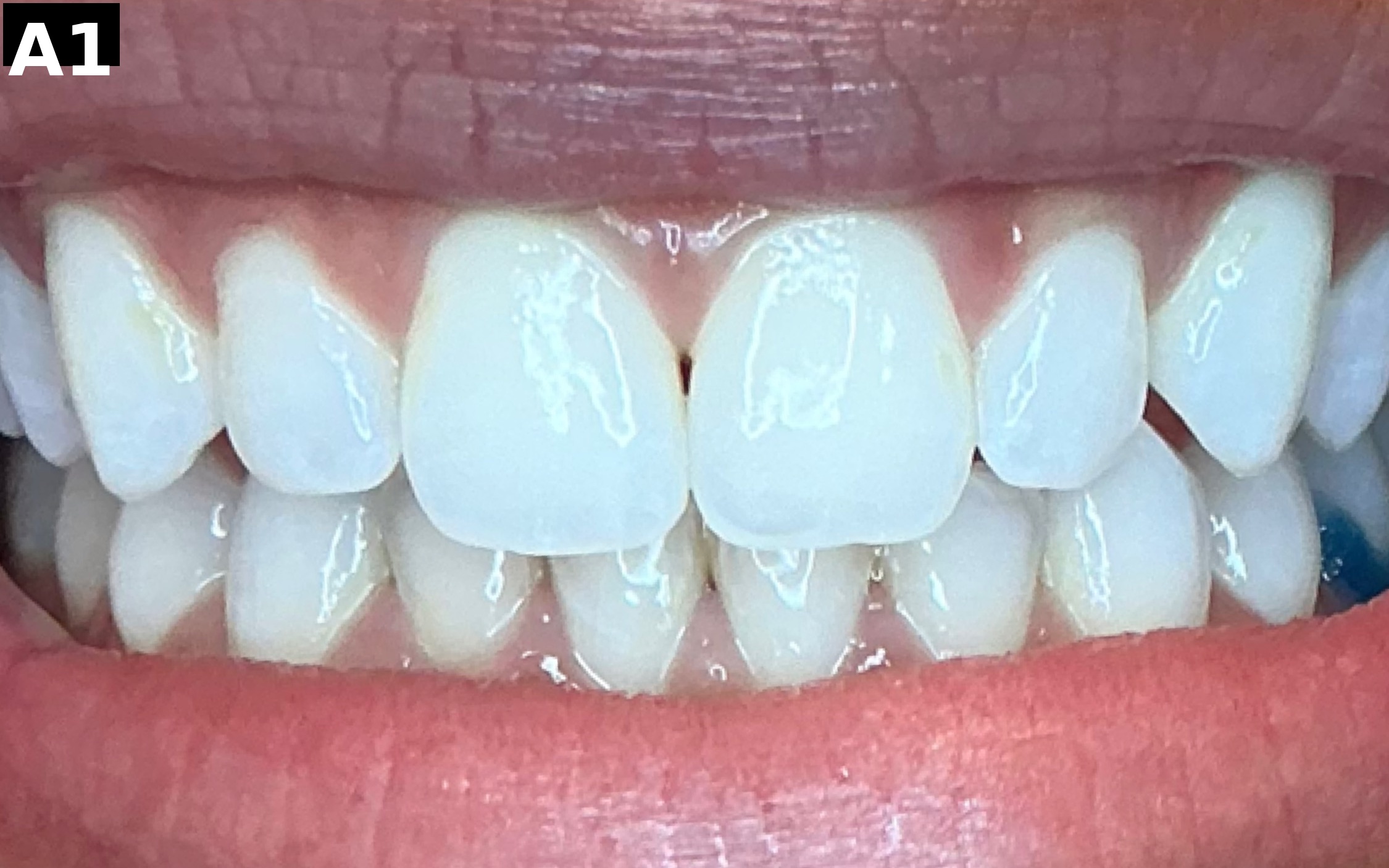 After teeth whitening