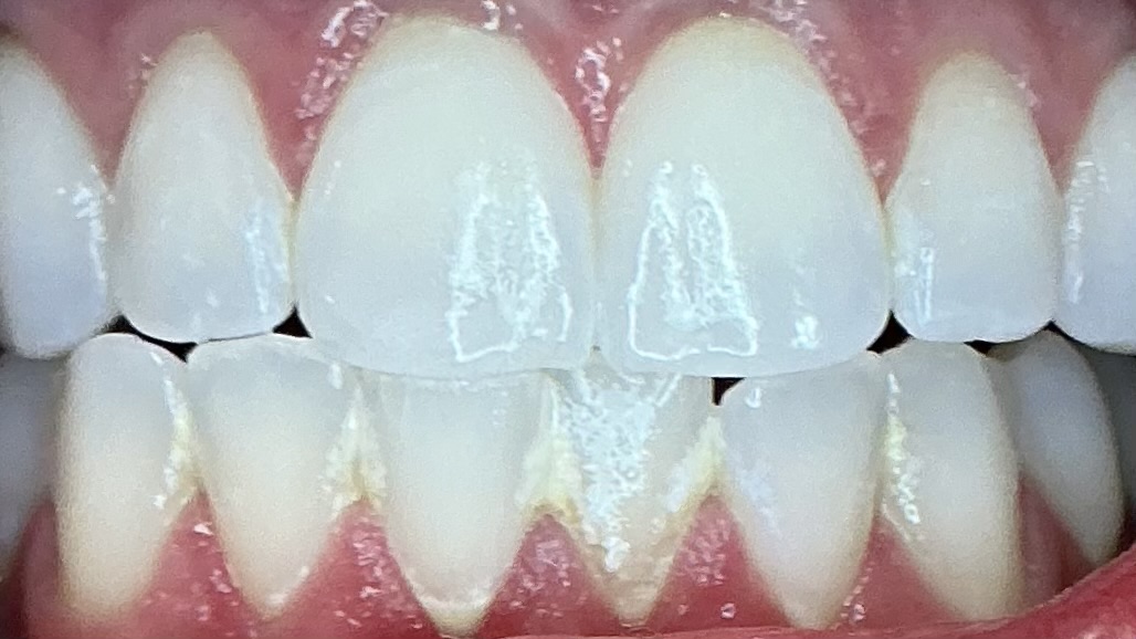 After teeth whitening