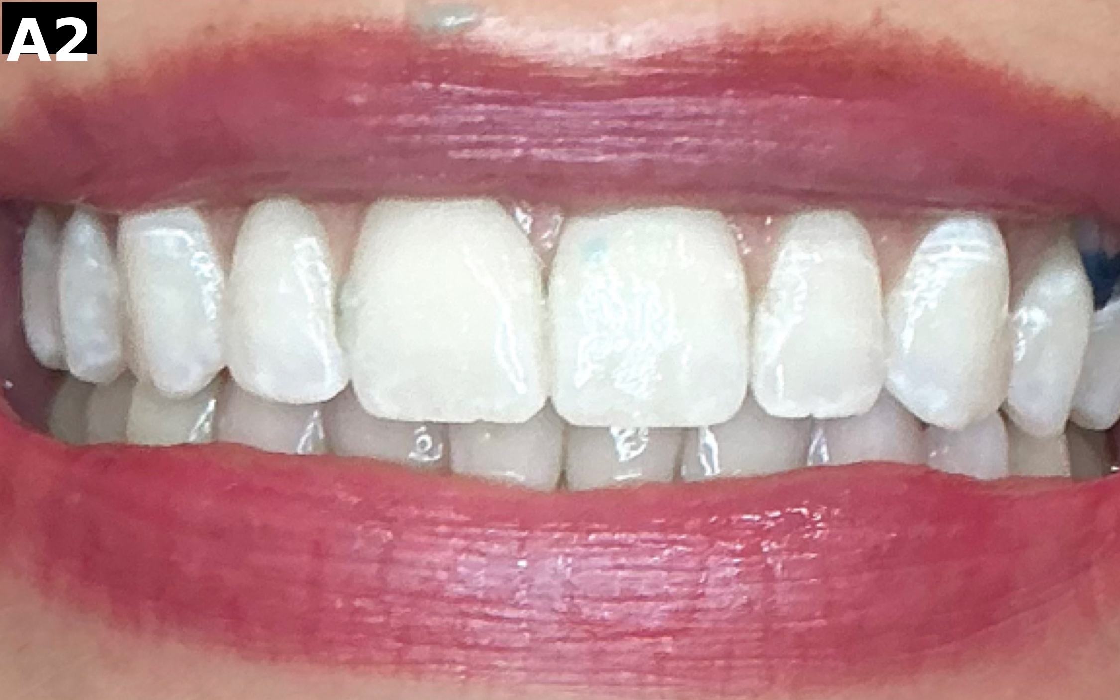 After teeth whitening