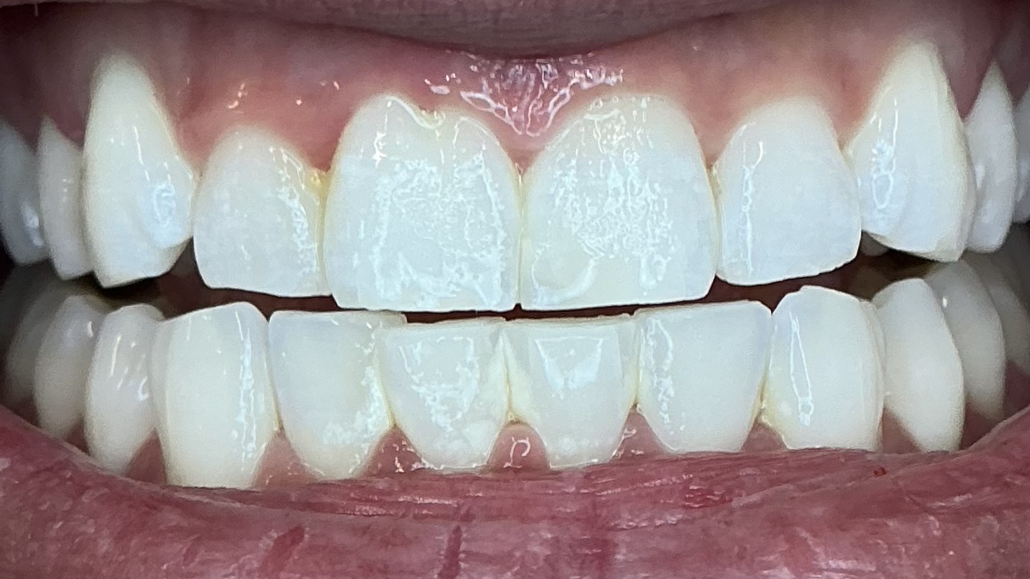 After teeth whitening