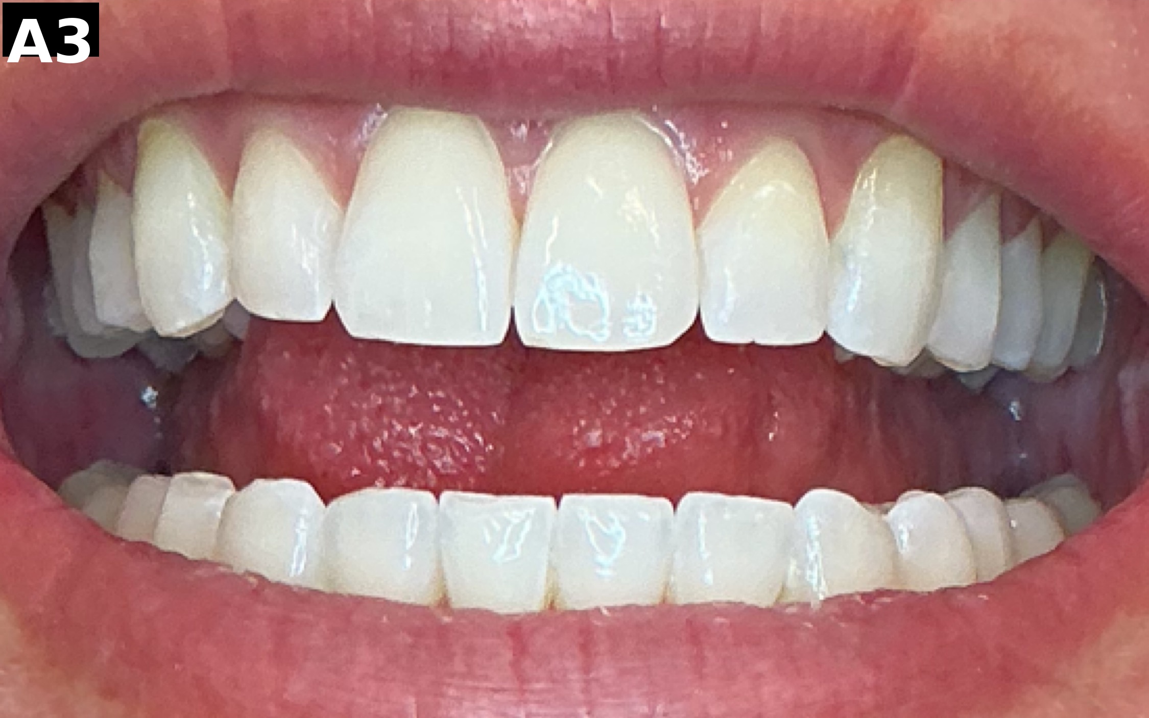 After teeth whitening