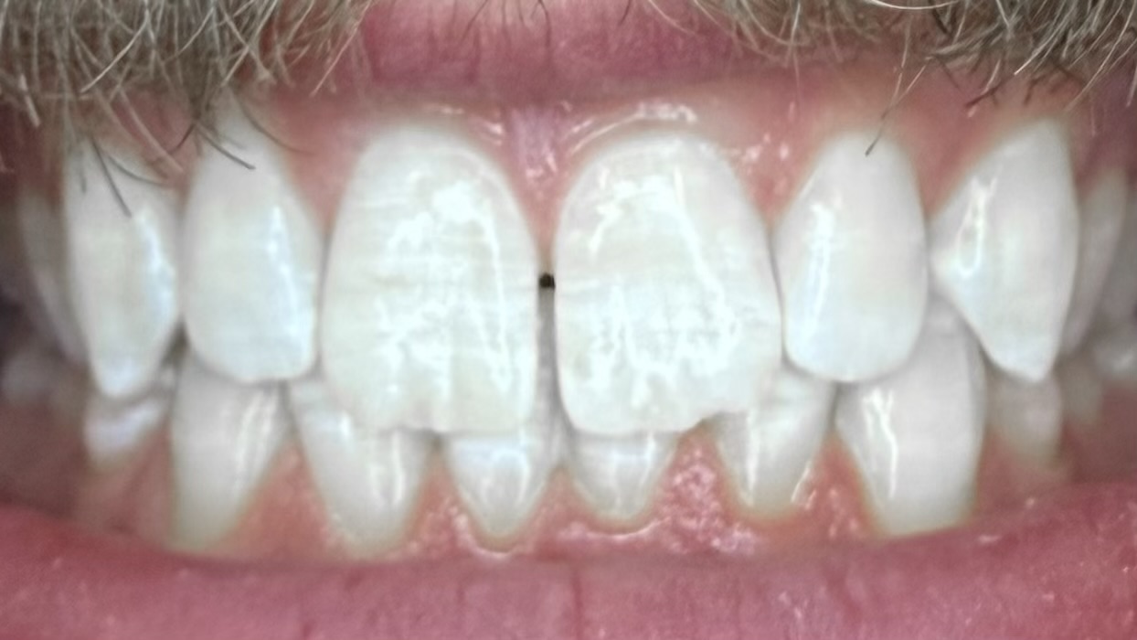 After teeth whitening