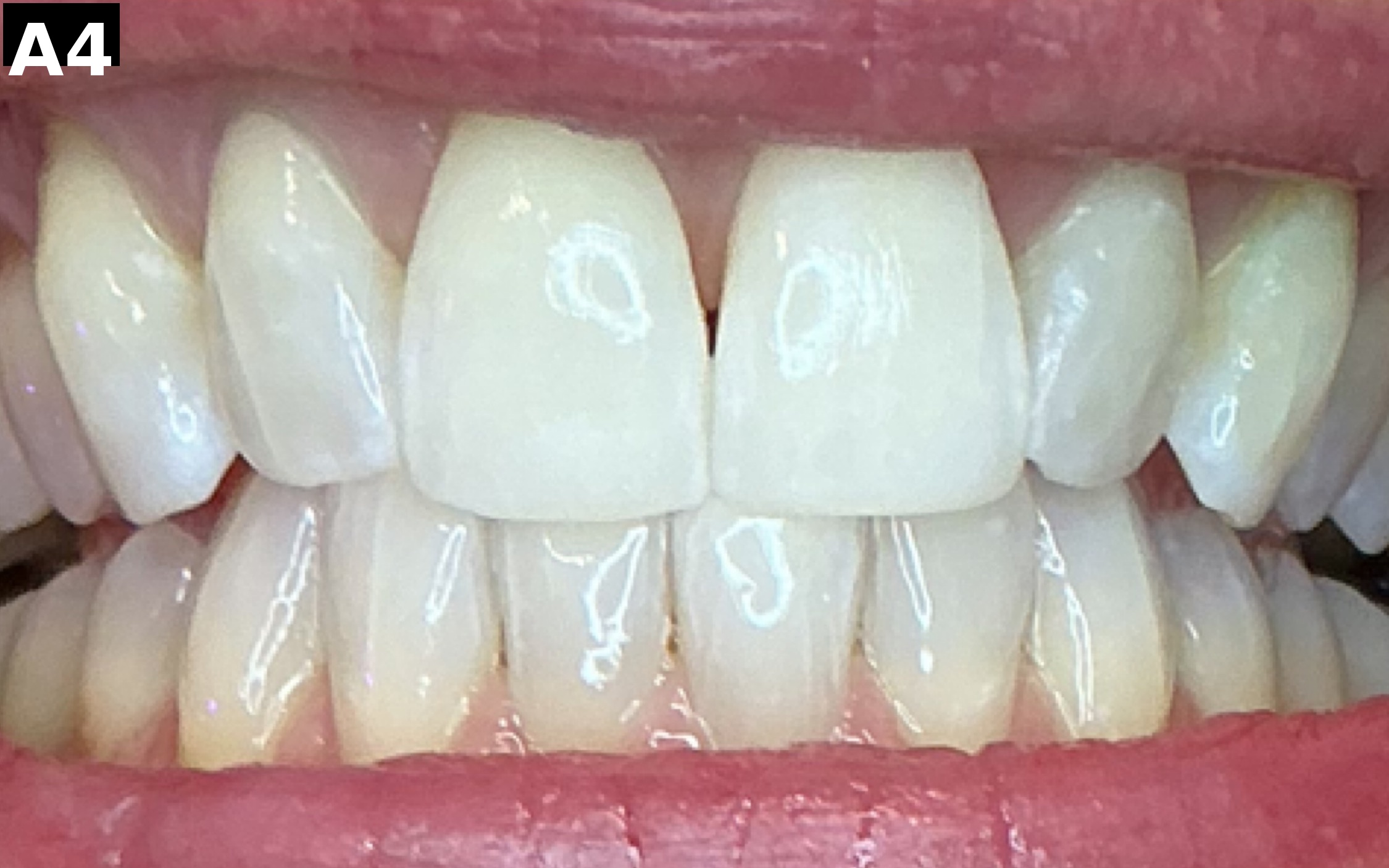 After teeth whitening