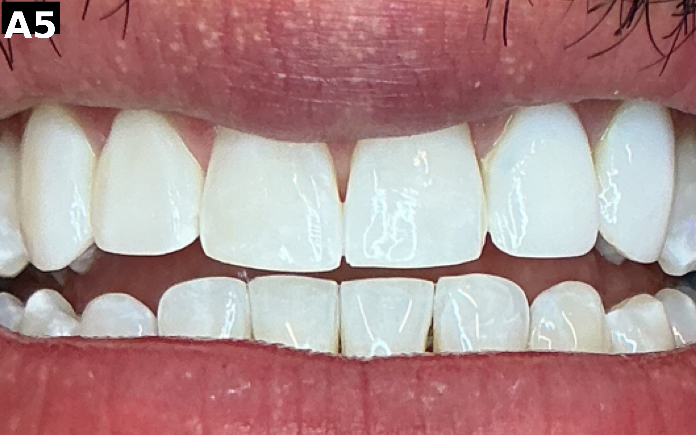 After teeth whitening