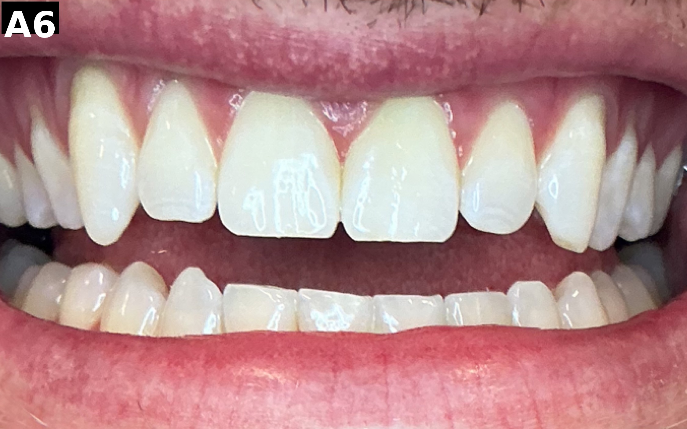 After teeth whitening