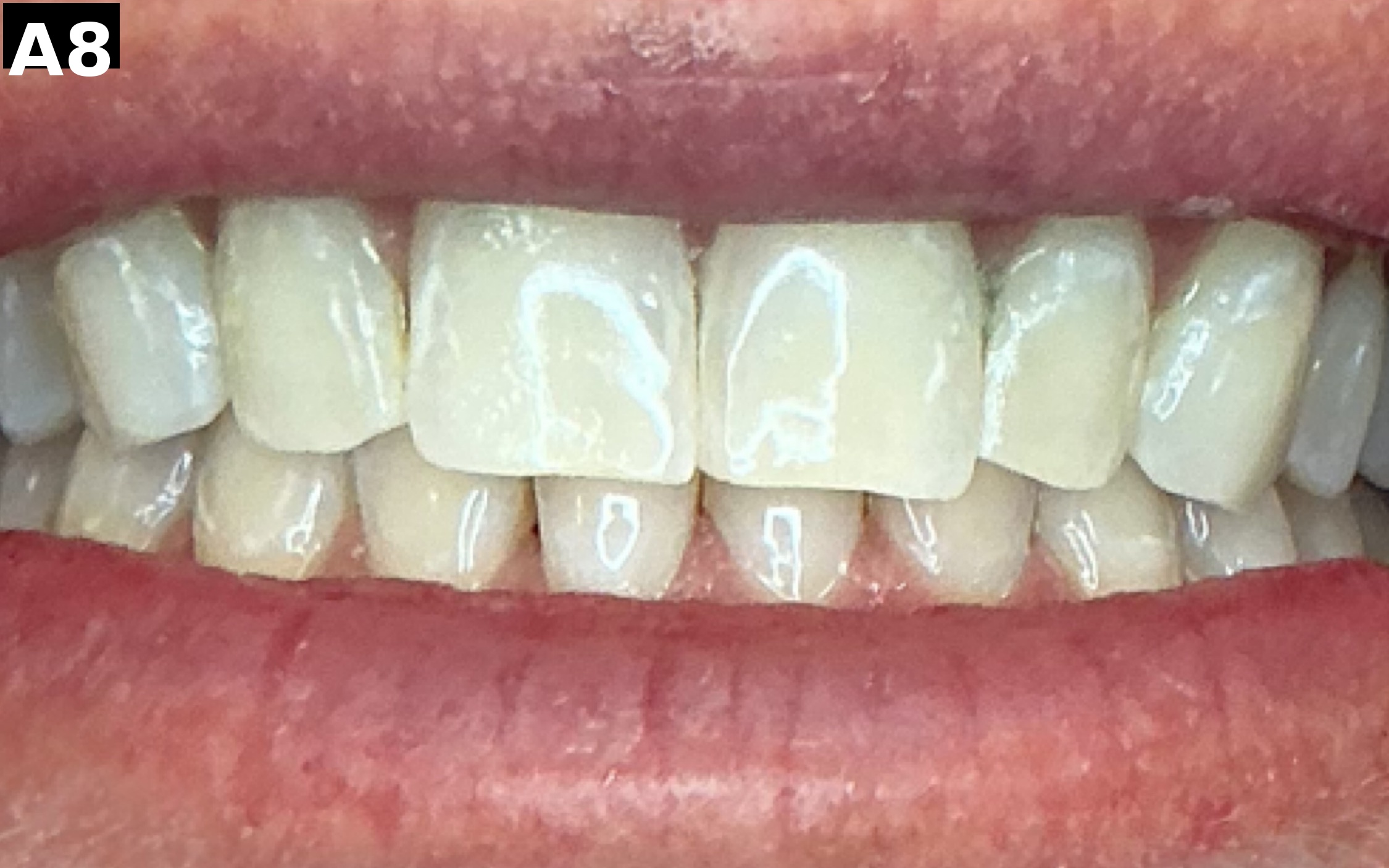 After teeth whitening