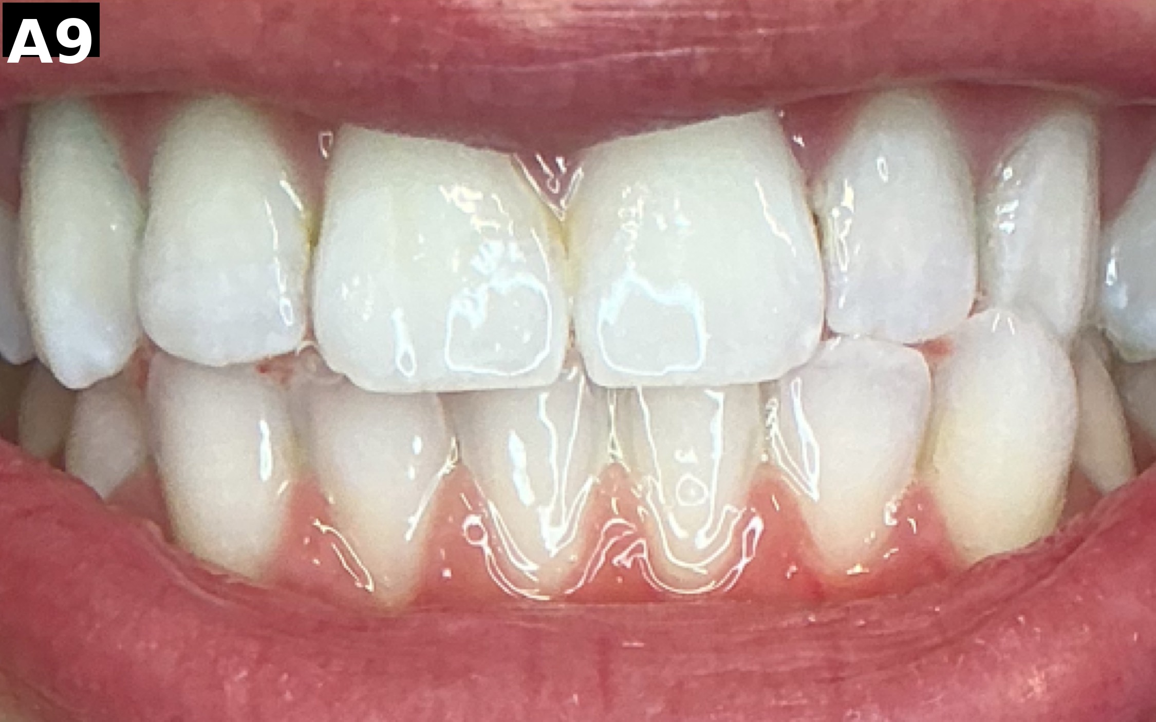 After teeth whitening