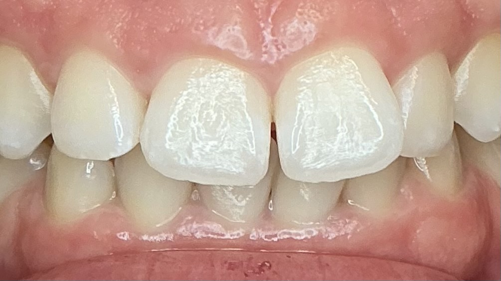 Before teeth whitening