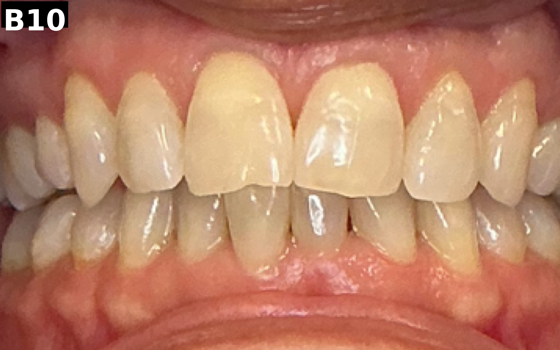 Before teeth whitening