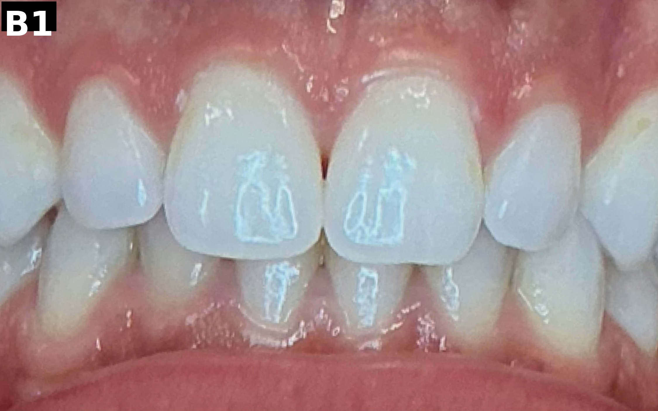 Before teeth whitening