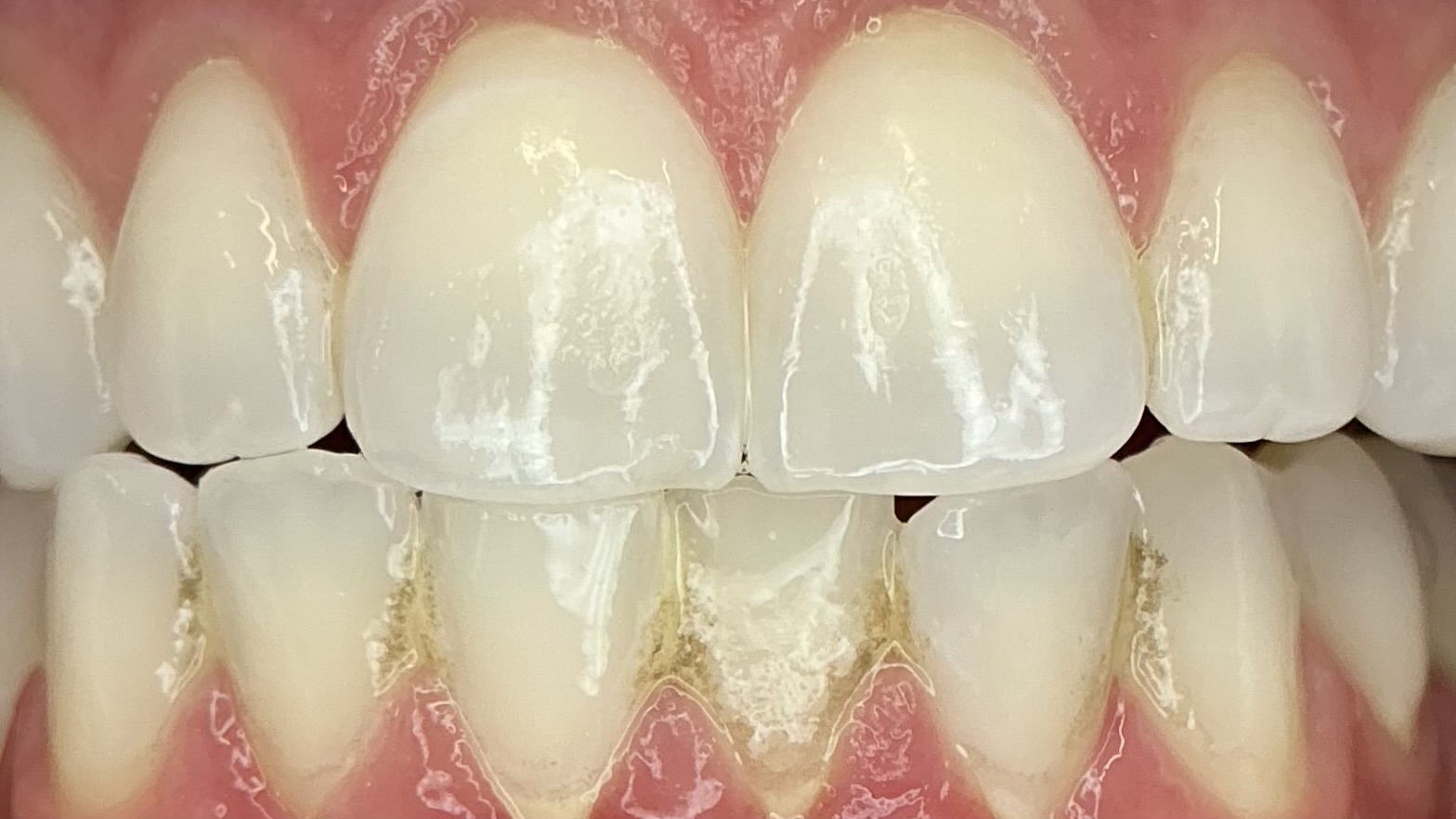 Before teeth whitening