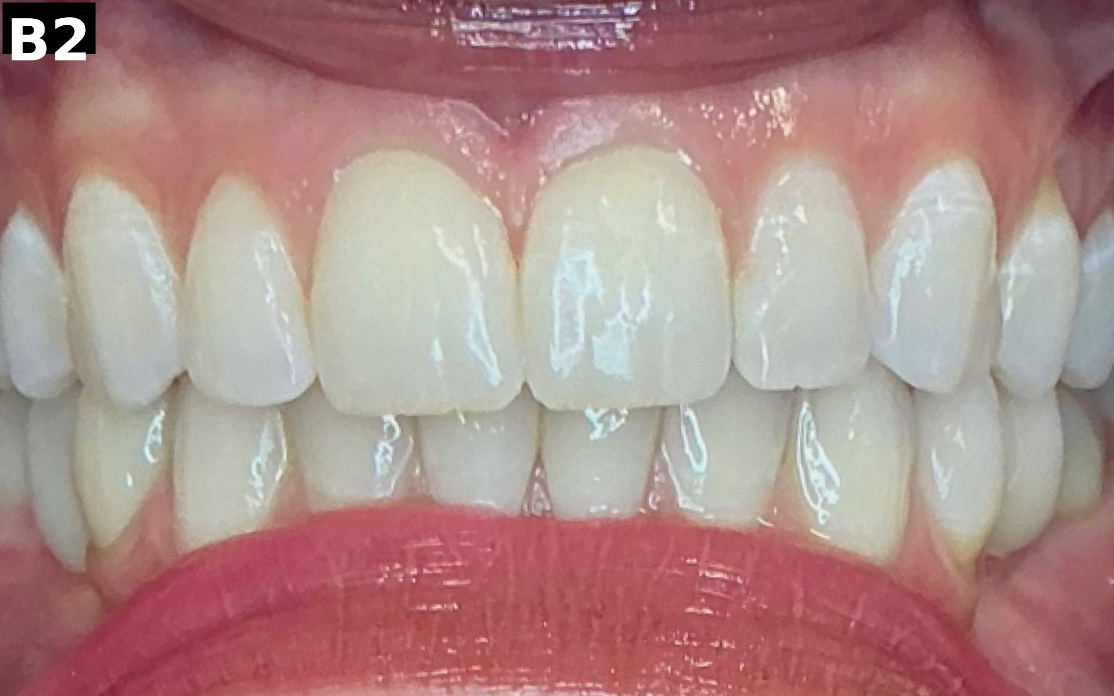 Before teeth whitening