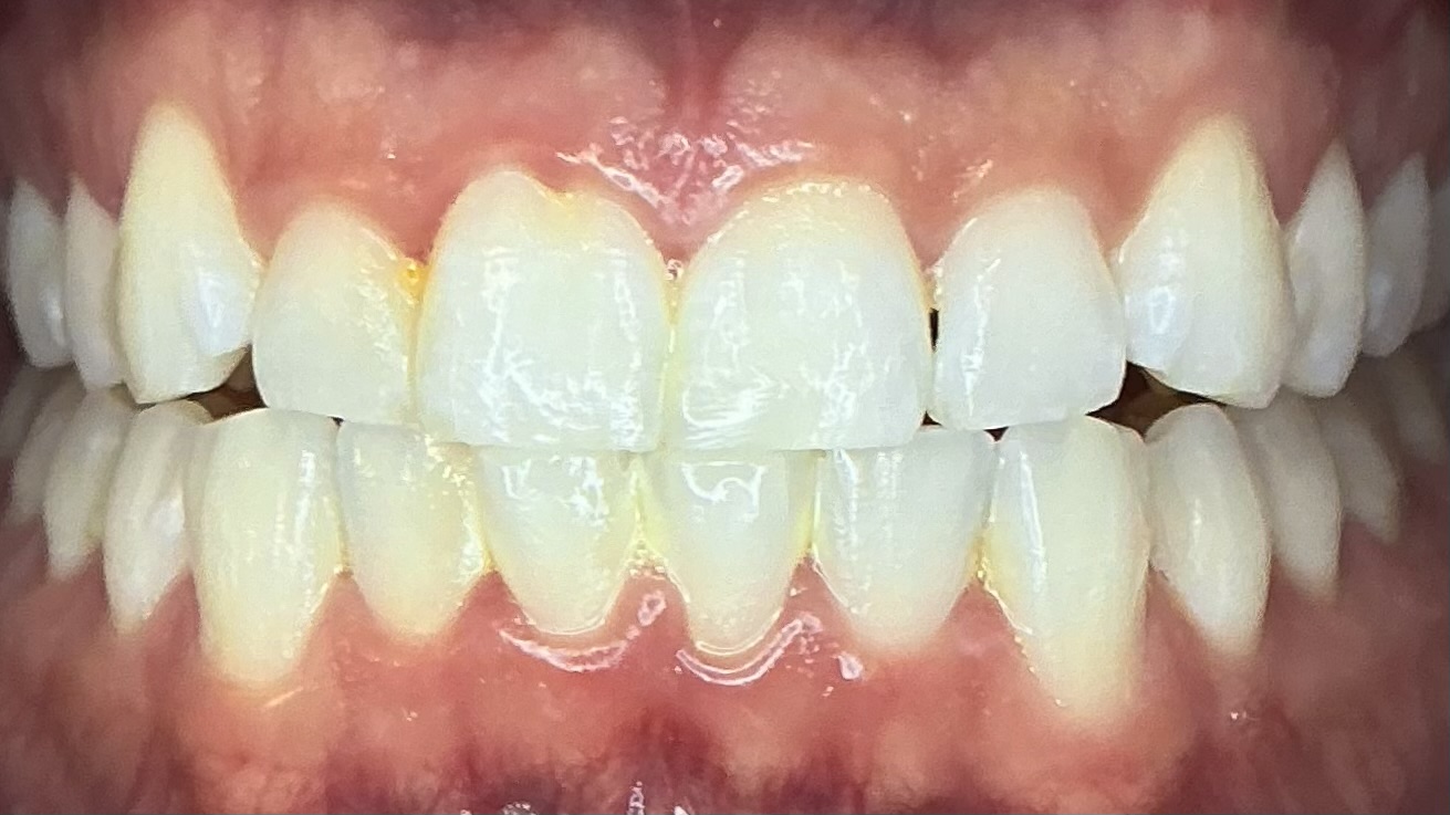 Before teeth whitening