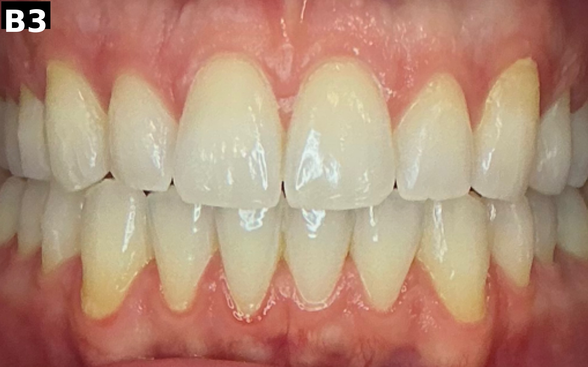 Before teeth whitening