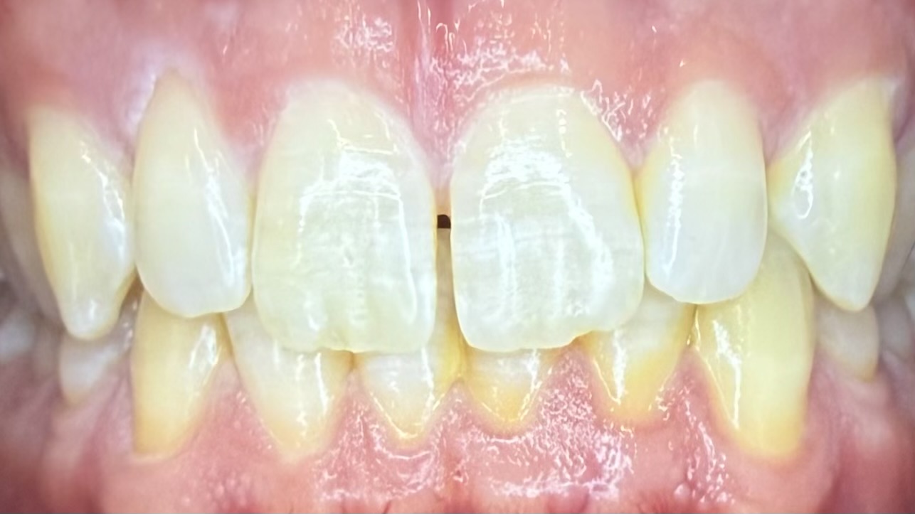Before teeth whitening