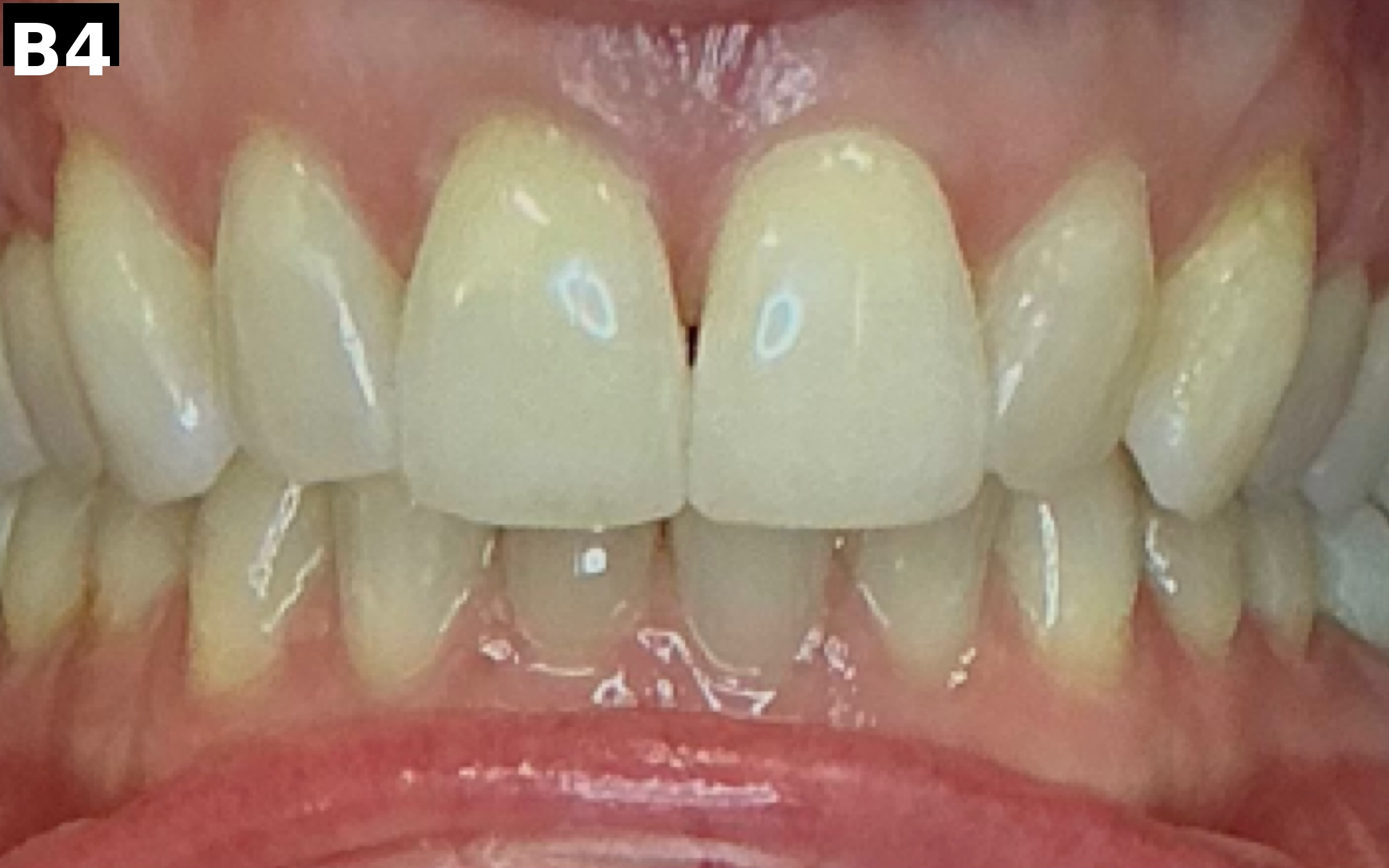 Before teeth whitening