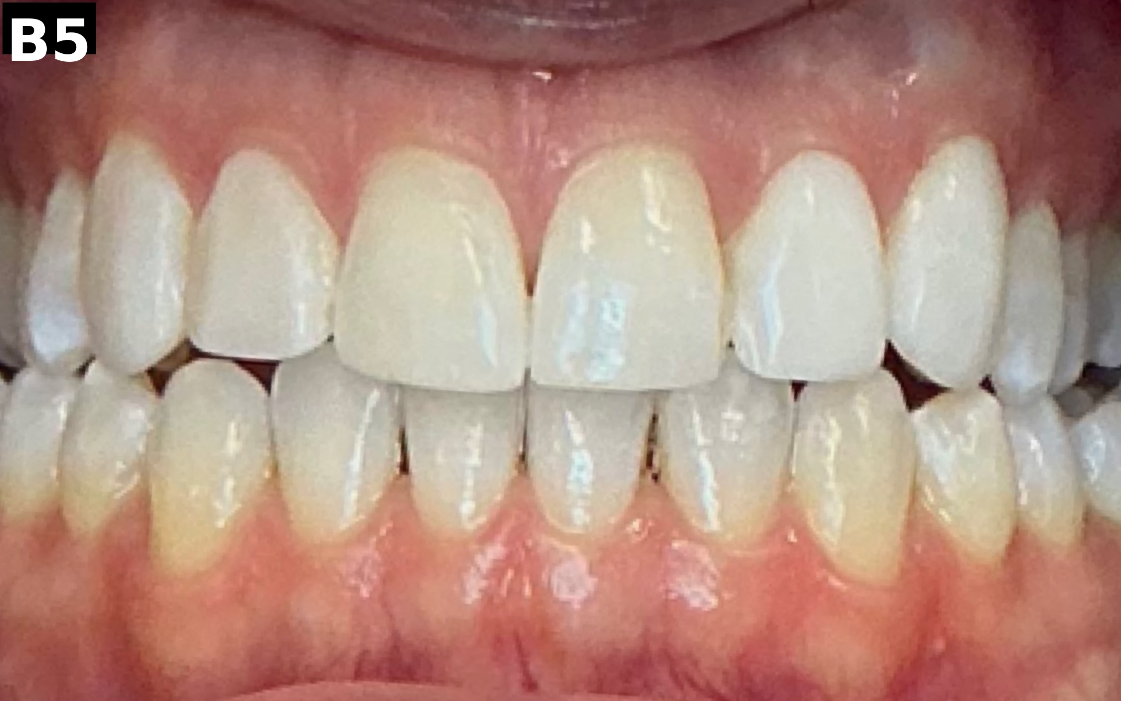 Before teeth whitening