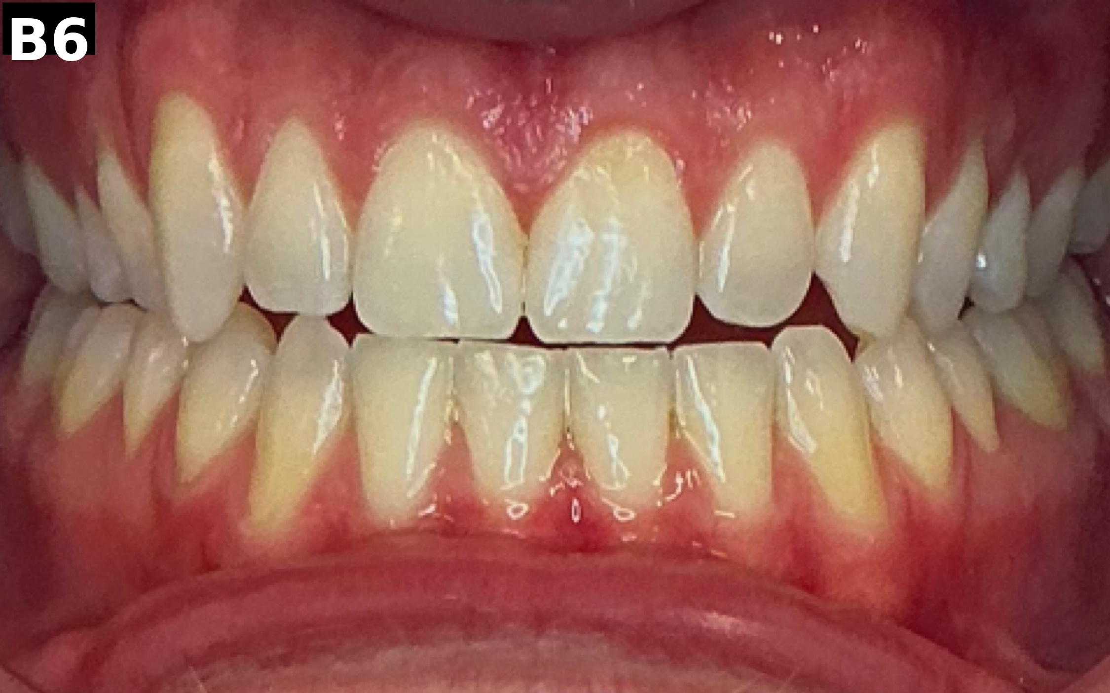 Before teeth whitening