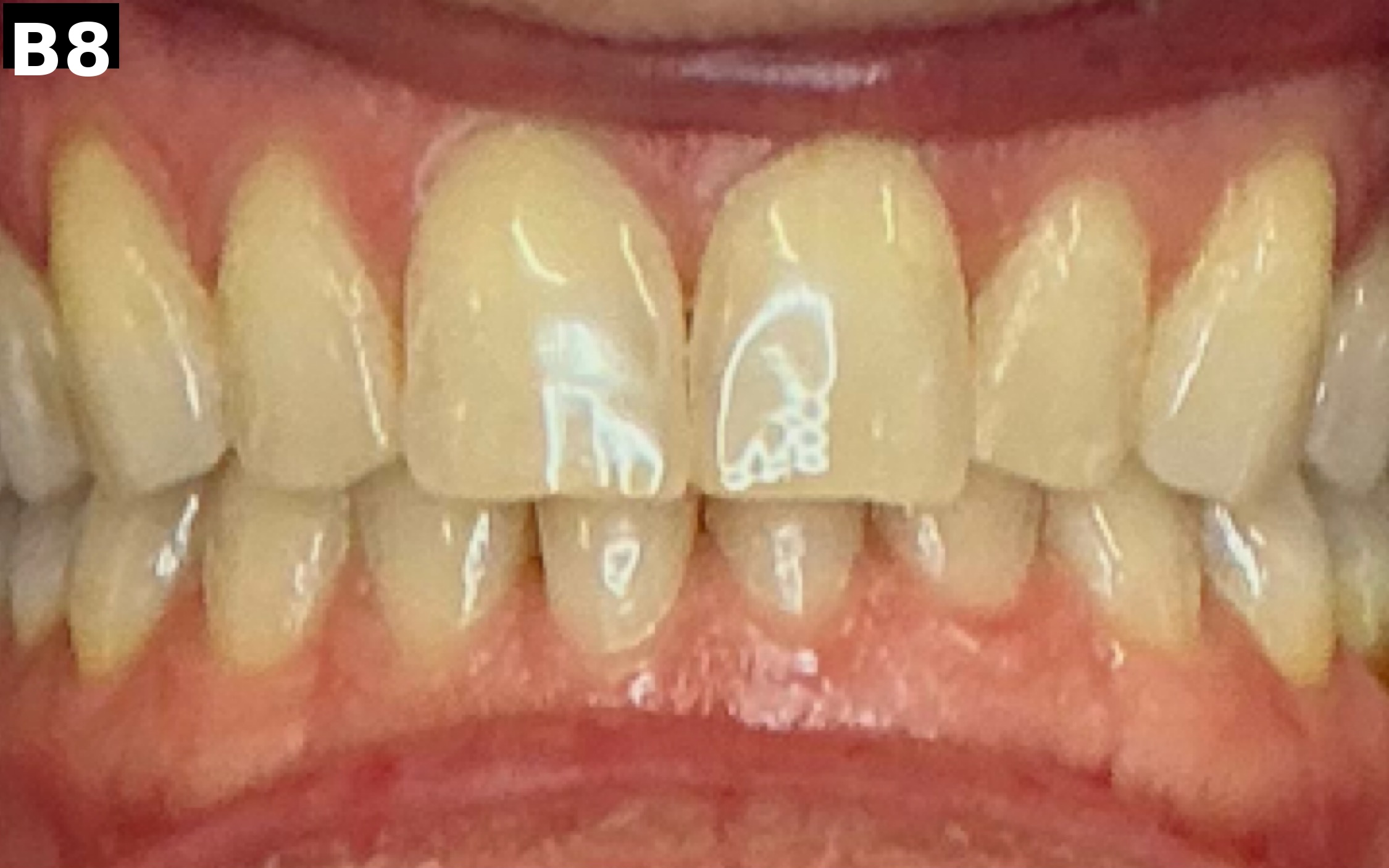 Before teeth whitening