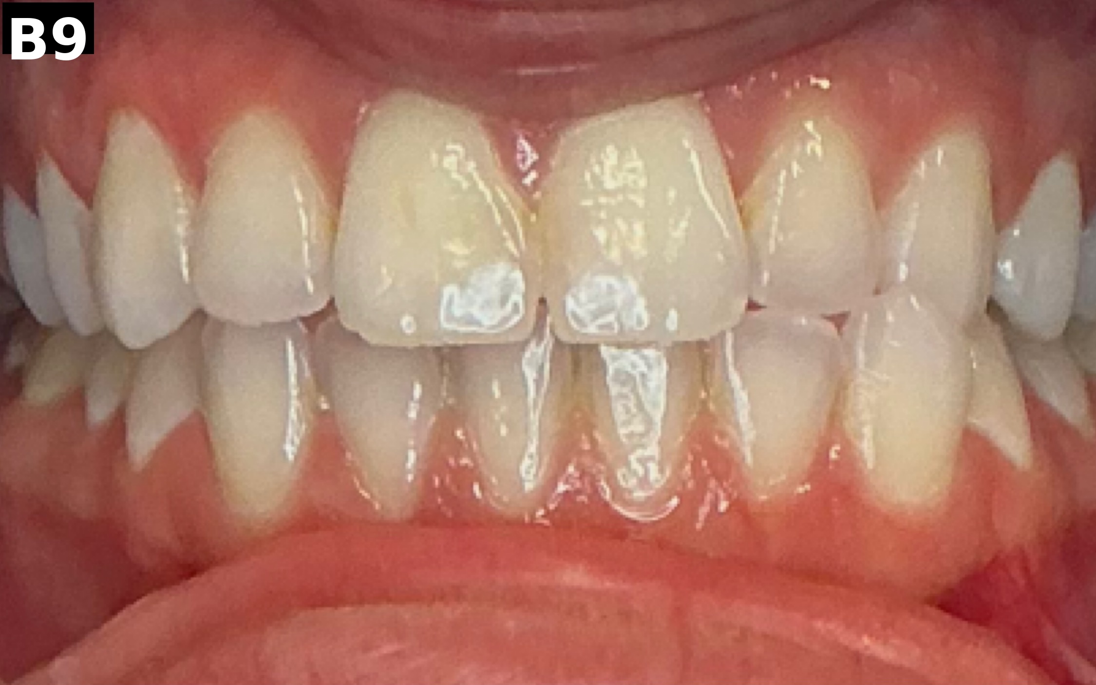 Before teeth whitening